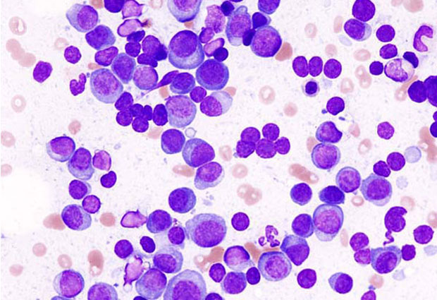 Histopathological image of multiple myeloma. IMAGE: HGH (CC BY 3.0). 