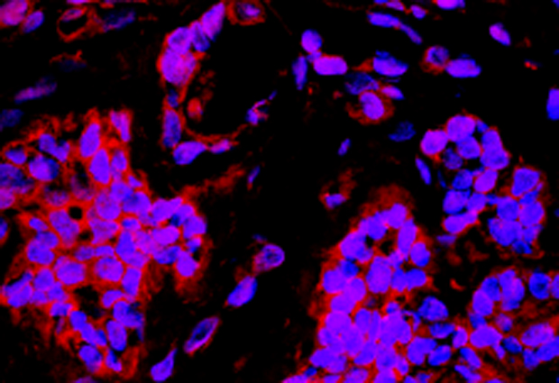 Human tumour sections expressing Herceptin (red), an antibody engineered by MultiBacTAG to recognize breast cancer cells. IMAGE: Ksenija Radic and Martin Jechlinger